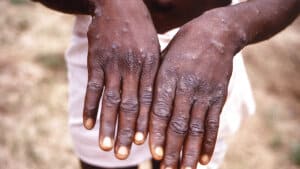 Sundhedsministeriet beskriver symptomerne på abekopper som blandt andet feber, kulderystelser og et udslæt med blærer, som kan give sår, når de heler. (Arkivfoto). Foto: Cdc/Brian W.j. Mahy/Reuters